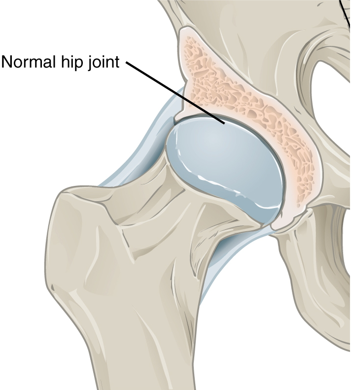 healthy hip joint with good cartilage