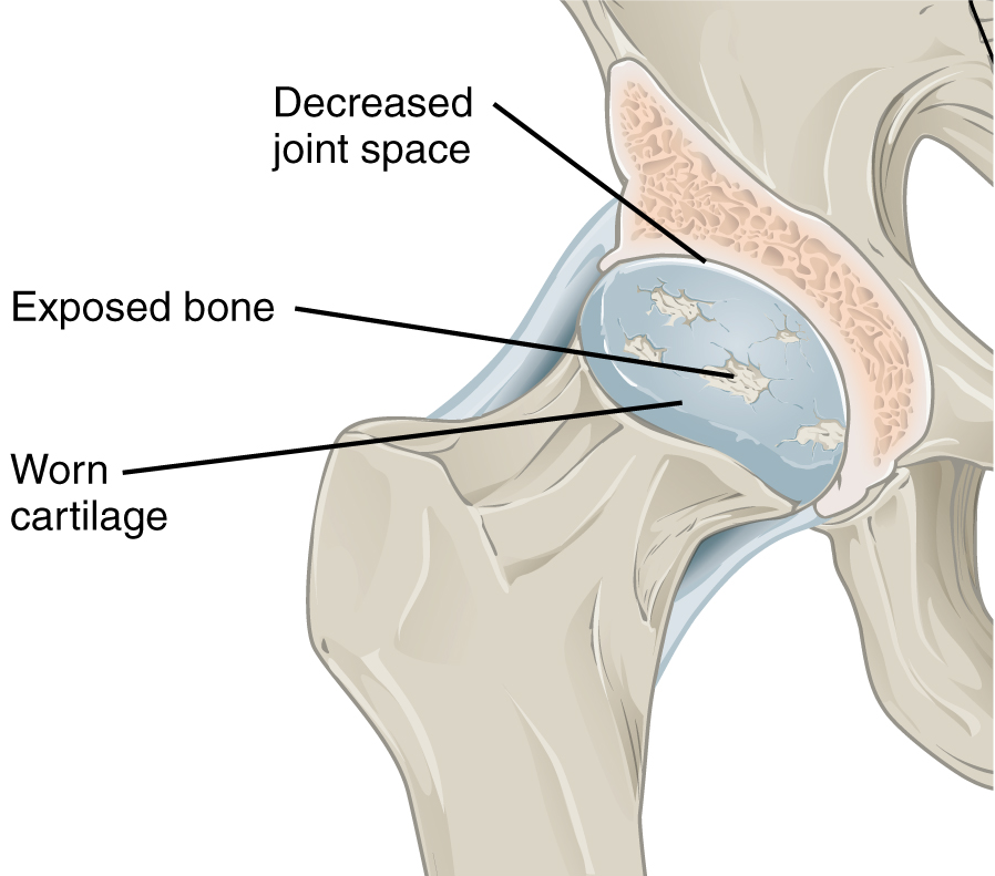 arthritis with narrowing joint space, damage