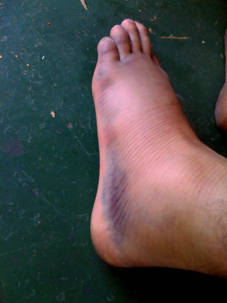 swollen ankle purple