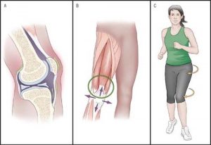 knee pain woman