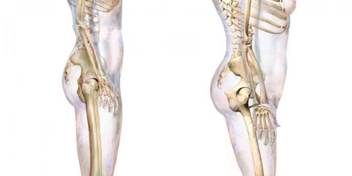 3 Treatment Videos For Your Hunchback Posture