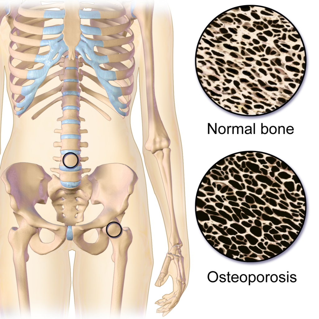 bone loss, osteoporosis