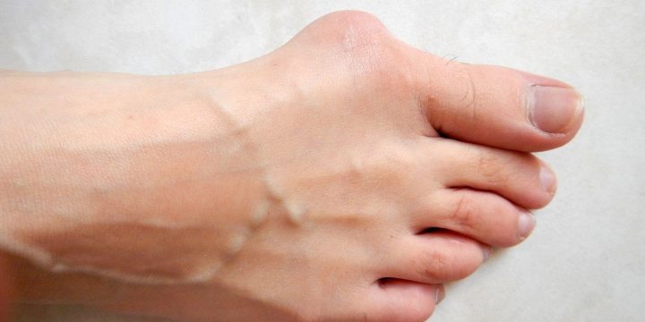 It’s Not Too Late to Fix Your Bunions