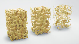 Bone appearance with and without osteoporosis
